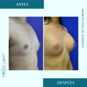 Mamoplastia de aumento