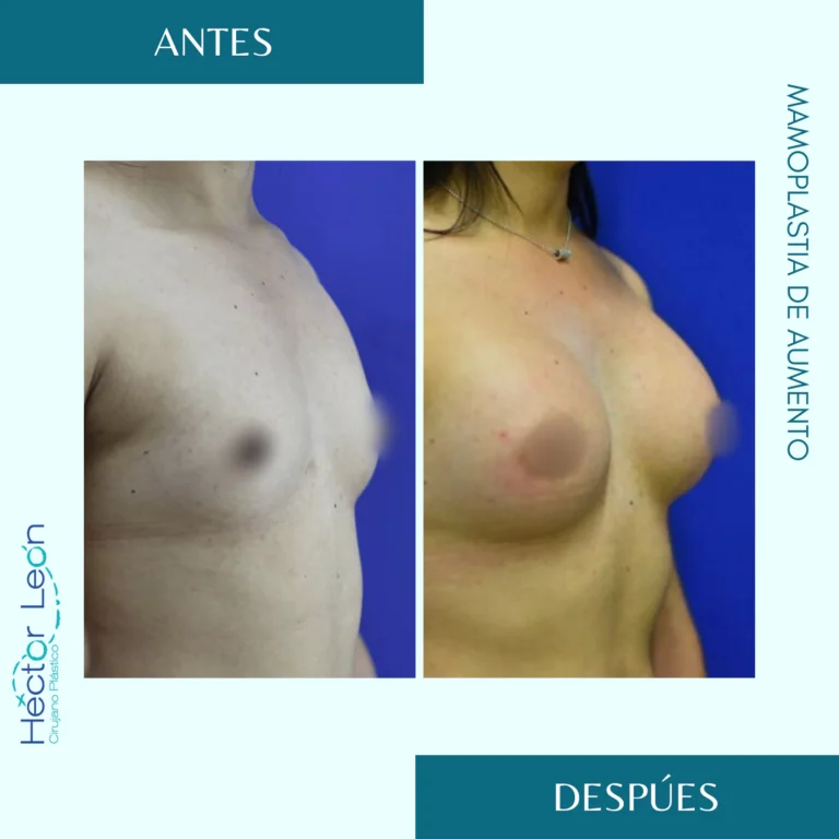 64- Mamoplastia de aumento