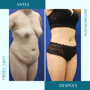 Lipoescultura, lipoaspiración o lipoplastia