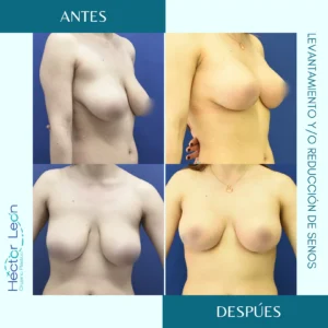 Levantamiento de senos