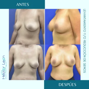 Levantamiento de senos y reducción de senos