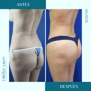 Glúteoplastia o Cirugía de glúteo