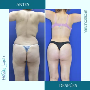 Lipoescultura, lipectomía por succión