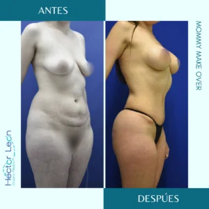 Mommy Make Over, transformación corporal del cuerpo de mamás