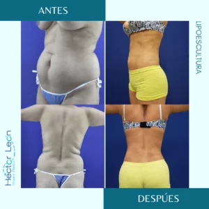 Lipoescultura, lipoaspiración, lipectomía